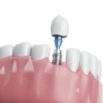 6.インプラント治療の期間はどのくらいかかりますか？