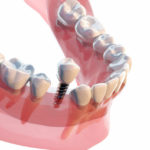 森 様（仮名）　2016年6月