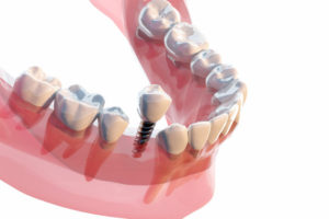 森 様（仮名）　2016年6月