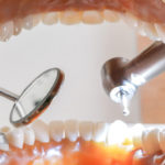 2.歯周病の人もインプラント治療は可能なの？